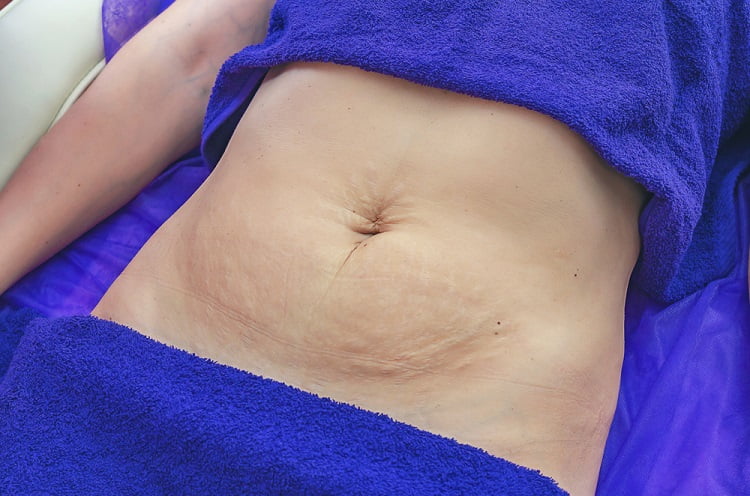 Loose Skin After Weight Loss