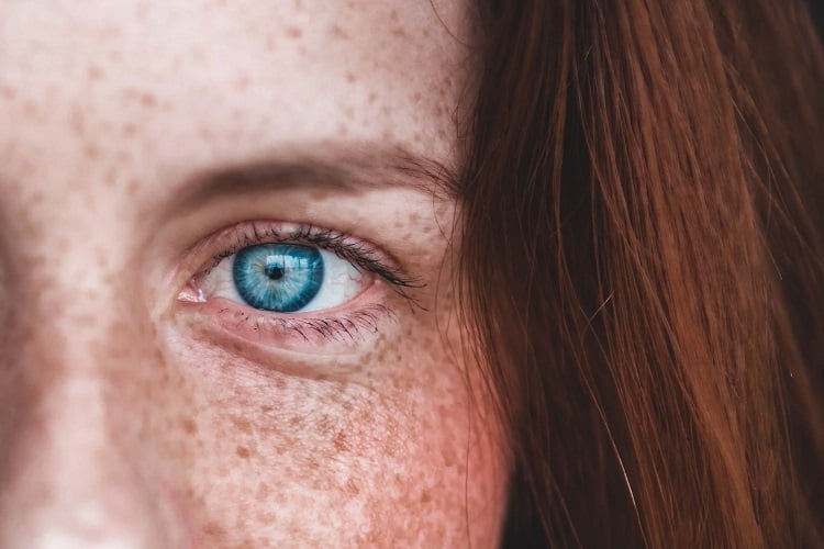 Melasma