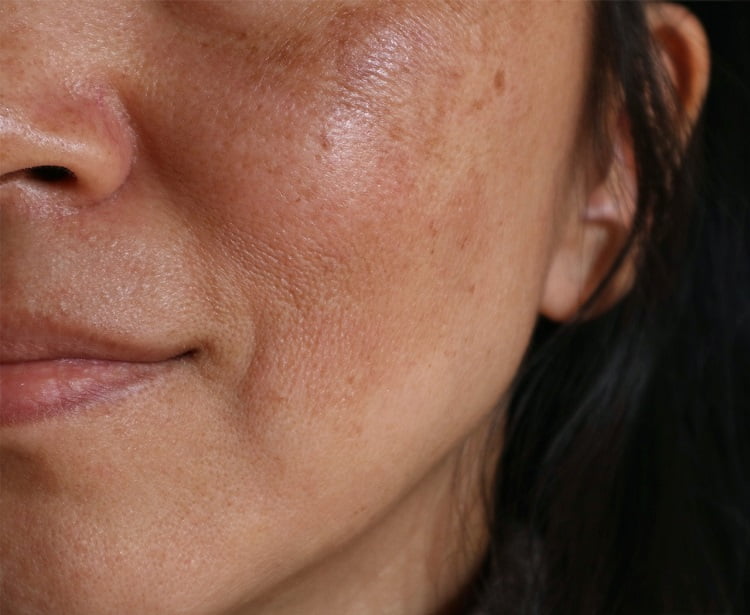 Hyperpigmentation