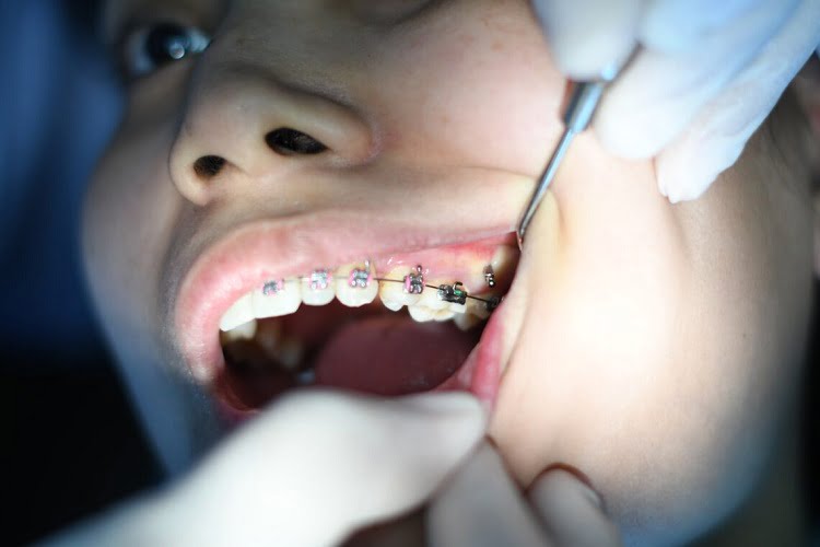Tooth Disease
